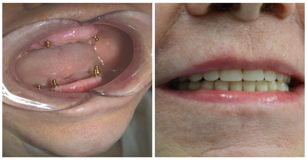 Upper Dentures Before And After Pictures Kelly LA 71441